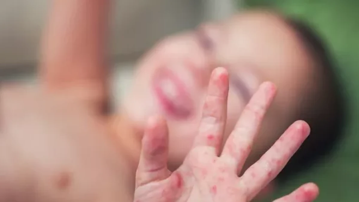 Kasus Campak Merebak, Kemenkes Minta Masyarakat Tidak Cium atau Gendong Bayi Saat Lebaran
