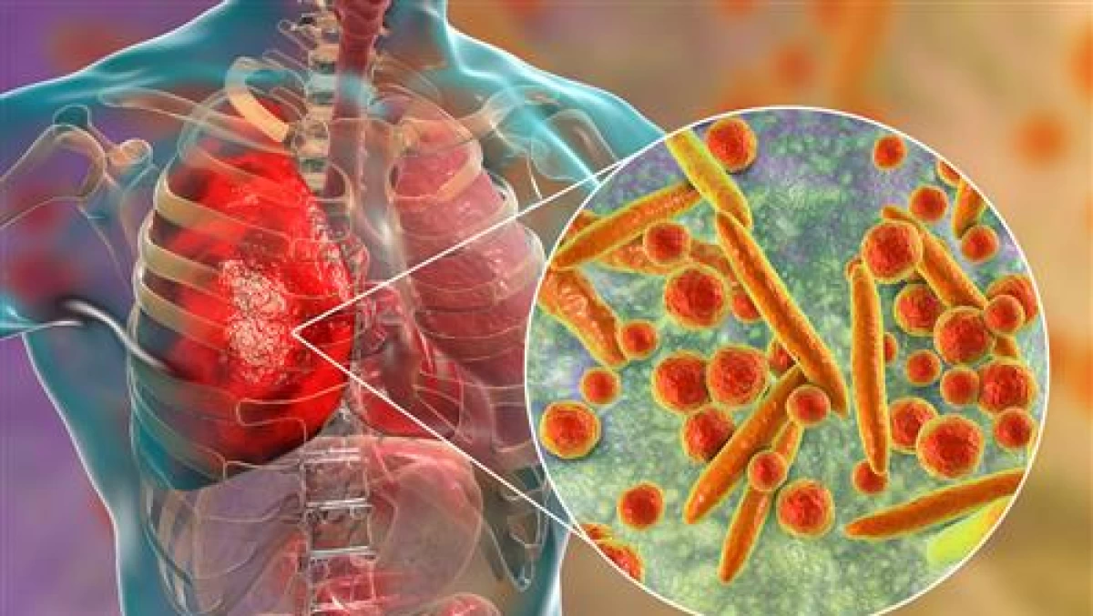 Mengenal Mycoplasma Pneumoniae, Bakteri yang Sedang Melanda di China