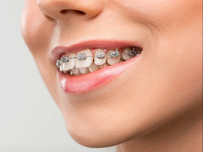 Hukum Besi Behel atau Kawat Gigi di Mulut saat Puasa
