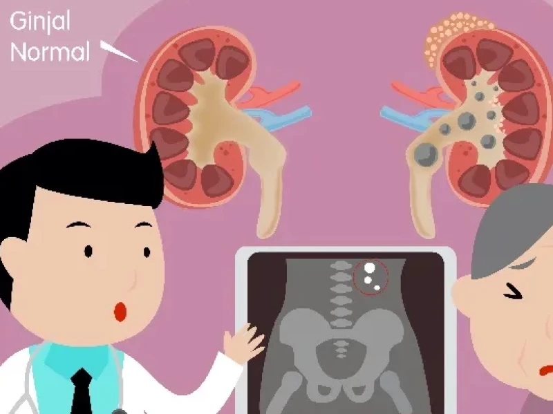 Preventif Agar Ginjal Tidak Terganjal