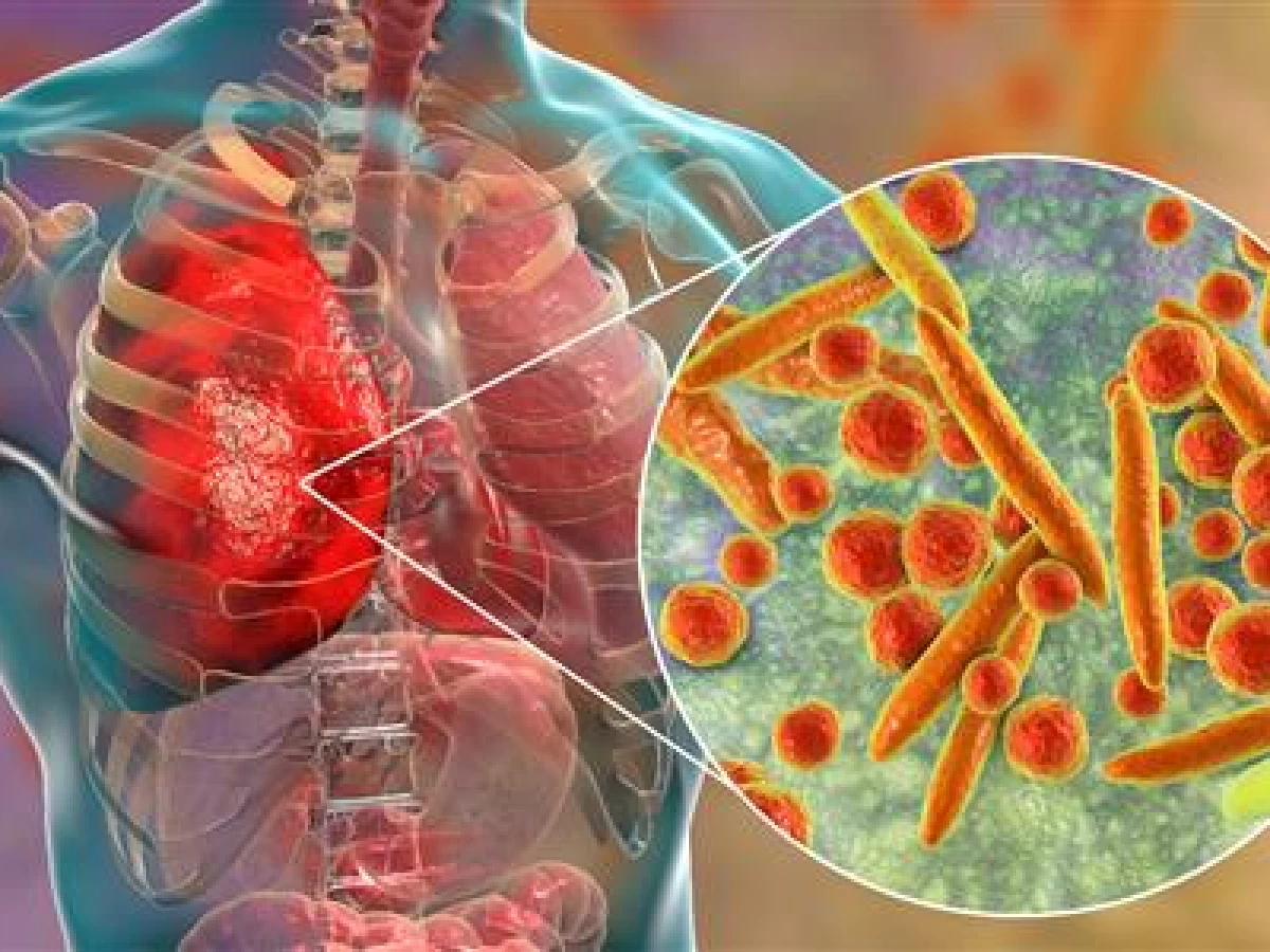 Mengenal Mycoplasma Pneumoniae, Bakteri yang Sedang Melanda di China